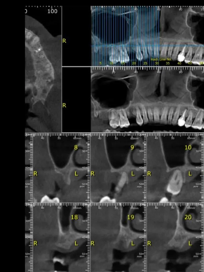 Secțiuni dintr-o tomografie dentară CBCT: osul maxilarului și rădăcinile dinților, în tonuri de gri.